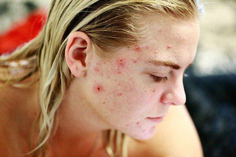 Remedios caseros para el acné - Tienda Naturista Pronapresa - Acné, Belleza, Bienestar, Consejos, Cuidado de la piel, Medicina Tradicional, Naturopatía, Salud