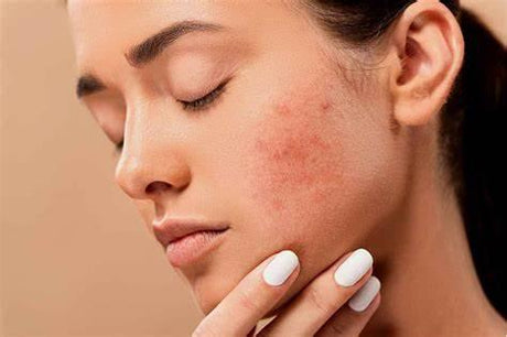 Acné: causas, factores de riesgo y cómo prevenirlo