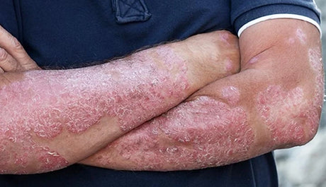 Consejos diarios para el cuidado de la psoriasis