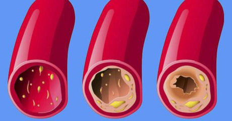 8 alimentos que te ayudarán a limpiar tus arterias 🤩 - Tienda Naturista Pronapresa - CIR-VIT, Colesterol, Consejos, Corazon, Salud
