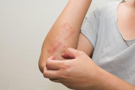 Alergias en la piel, por qué las sufrimos y cómo podemos evitarlas