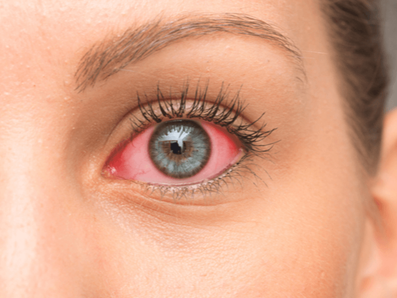 ¿Sabías que la artritis afecta a la vista?