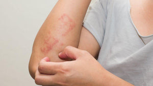La constancia es clave para controlar la dermatitis atópica