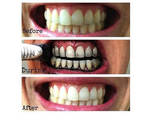 Blanqueador Dental de Carbón Activado  antes y después